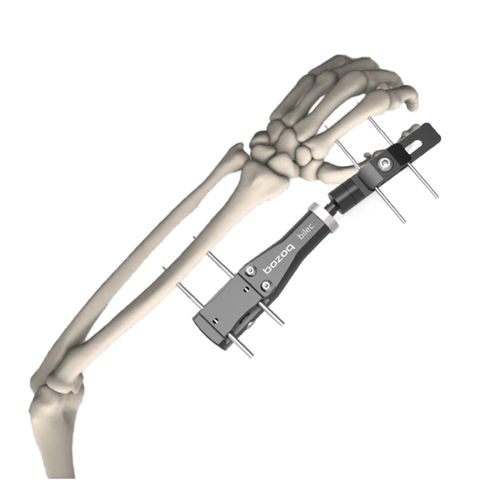 Robotic Fixator for Distal Radius Fracture