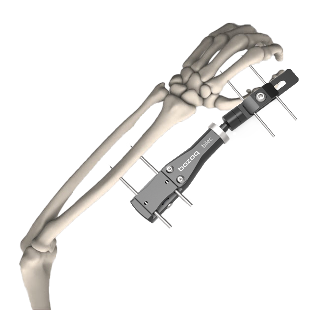 Bilec Wrist Fixator