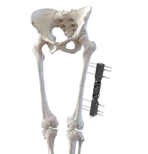 Warac Unilateral Fixator System